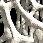 Osteoporosis Menyerang Perempuan Muda